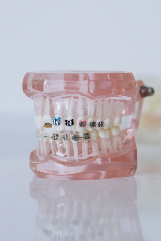 jakie-sa-aparaty-ortodontyczne