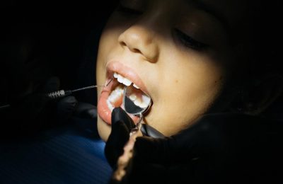 Szczelina między zębami